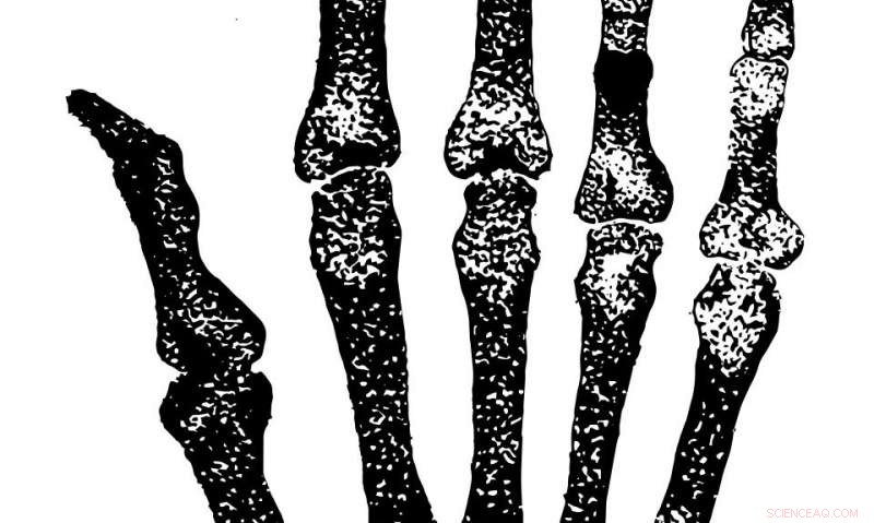 Elbow Bone Analysis Improves Sex Identification in Thai Skeletons