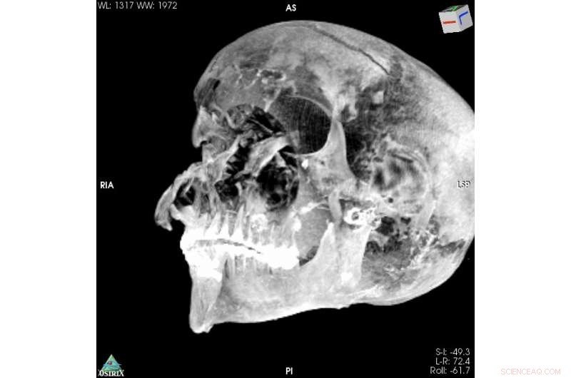 CT Scans of Egyptian Mummy Unveil New Details on the Death of a Pivotal Pharaoh