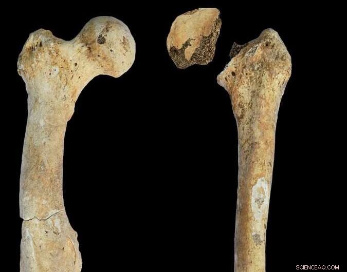 Bronze Age Rare Diseases: Uncovering Insights from the North Caucasus