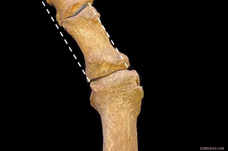 Pointed‑Toe Shoes and the Rise of Bunions in Medieval Britain: New Findings