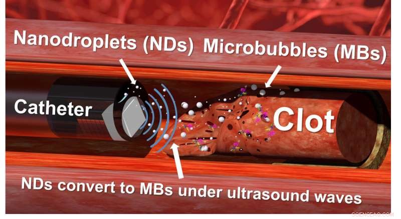 Ultrasound-Activated Nanodroplet Technique Breaks Down Stubborn Blood Clots