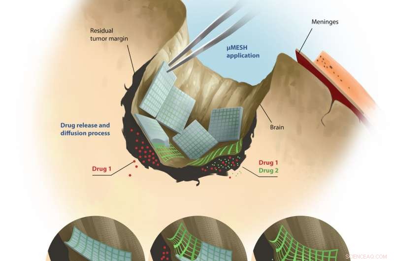 MicroMESH: Precision Polymeric Network for Targeted Glioblastoma Treatment