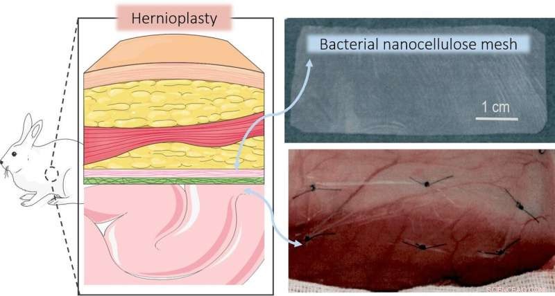 Bio-Nanocellulose Meshes Boost Hernia Repair Success