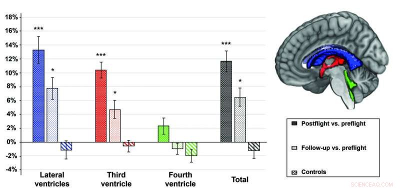 Long Space Missions Linked to Brain Ventricle Enlargement, New Study Finds