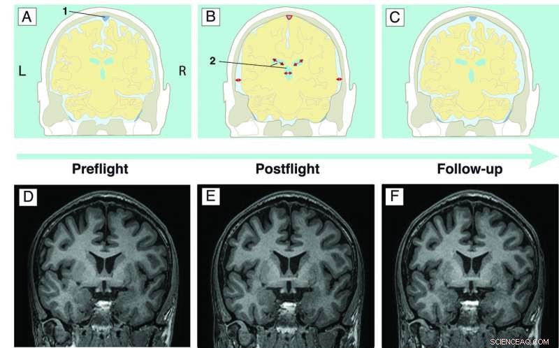 Long Space Missions Linked to Brain Ventricle Enlargement, New Study Finds
