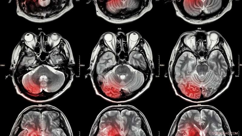 Petroleum Refinery Pollution Linked to Higher Stroke Rates in Southern U.S. Residents