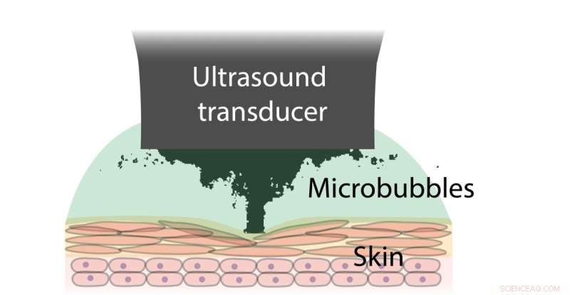 Ultrasound‑Induced Microbubbles Enhance Bandage Adhesion for Wet Skin Applications