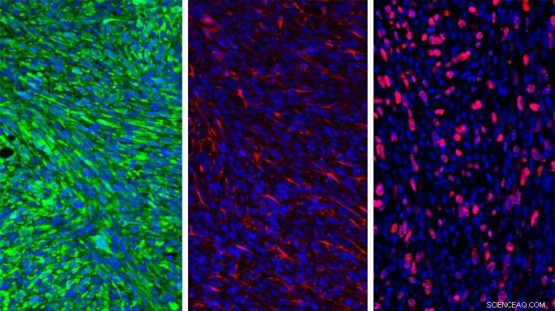 Nanoparticle-Delivered Inhibitor Activates Immune Response to Overcome Brain Cancer