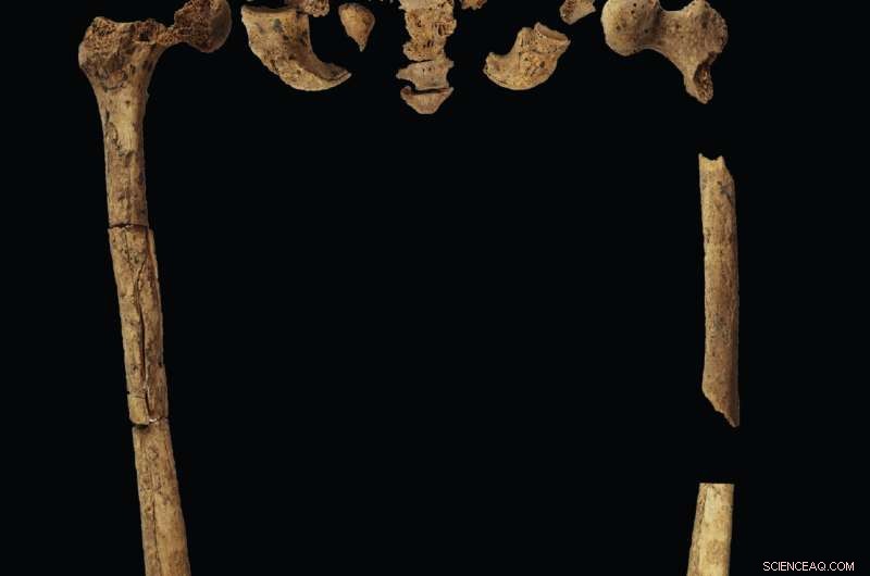 31,000-Year-Old Borneo Skeleton Missing Foot Reveals Earliest Known Amputation