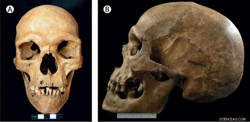 Ancient Skeleton Yields Earliest Known Case of Klinefelter Syndrome