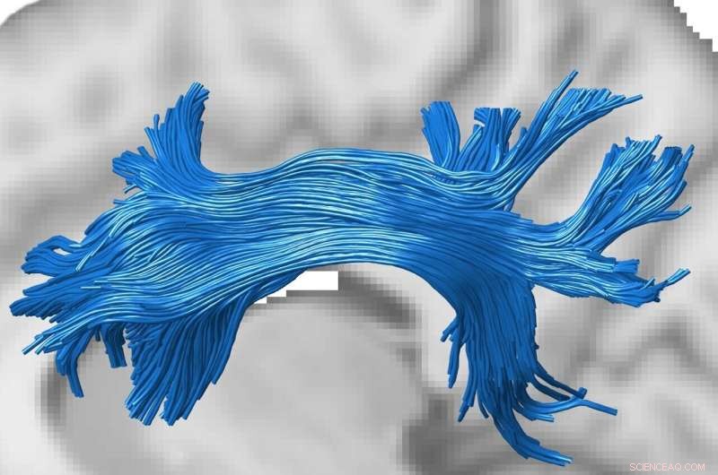 GPU-Powered Machine Learning Algorithm Enhances Human Brain Connectivity Mapping