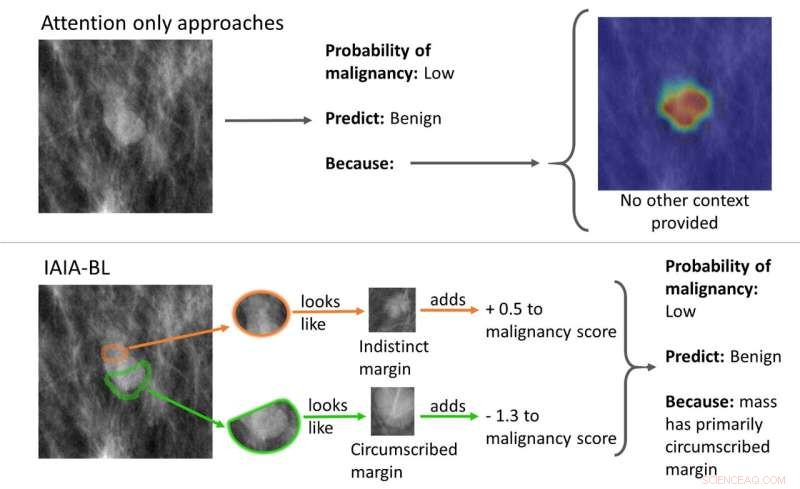 Transparent AI Breakthrough: First System to Explain Breast Cancer Diagnoses in Mammography
