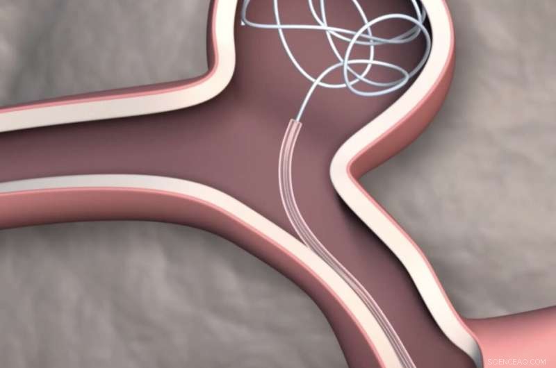 Revolutionary Steerable Catheter Enhances Precision in Brain Surgery