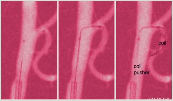 Revolutionary Steerable Catheter Enhances Precision in Brain Surgery