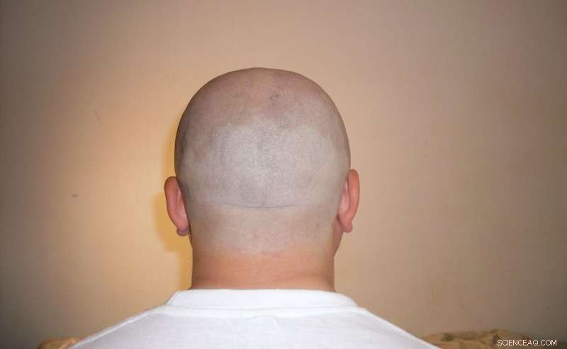 Scientists Discover Key Chemical That Regulates Hair Follicle Cell Growth and Death