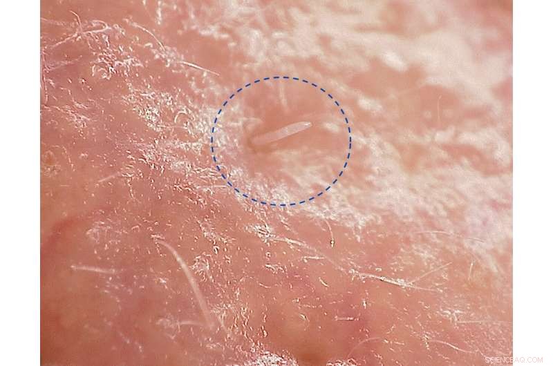 Inside the Skin: How Demodex Mites Influence Facial Health