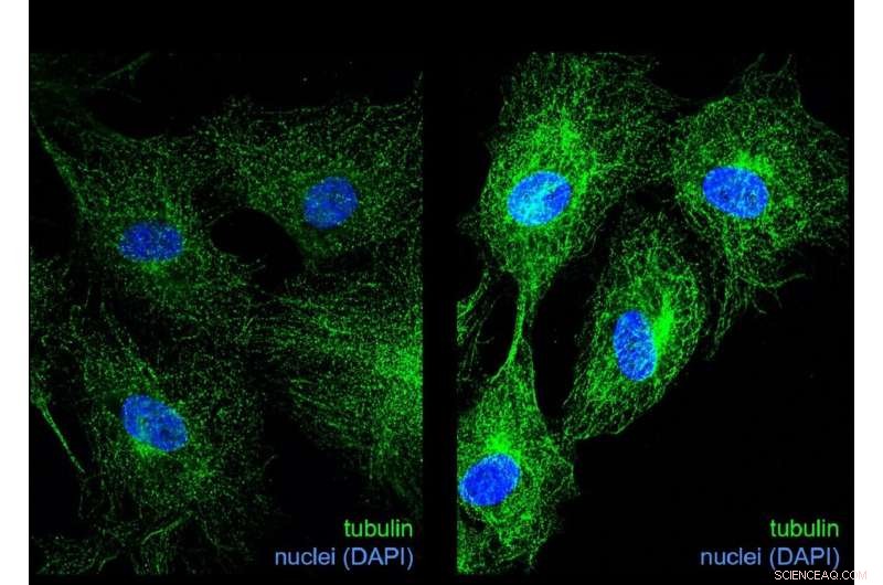 Glycation and Age-Related Disease: How Protein Dysfunction Develops