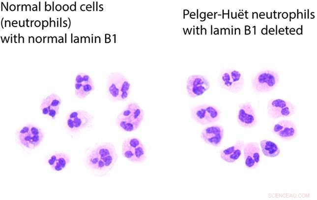 Gene Deletion Linked to Abnormal Blood Cancer Cell Nuclei