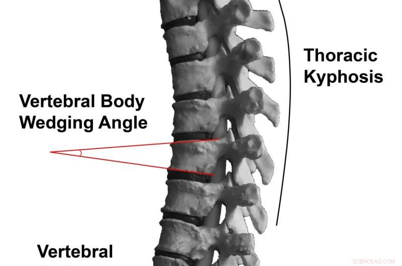 Neanderthal Spine Analysis May Unlock Secrets to Lower Back Pain