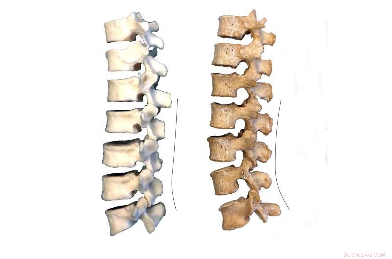 Neanderthal Spine Analysis May Unlock Secrets to Lower Back Pain