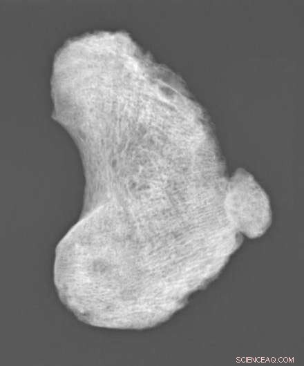 Understanding the History of Hib Disease and Vaccine Impact