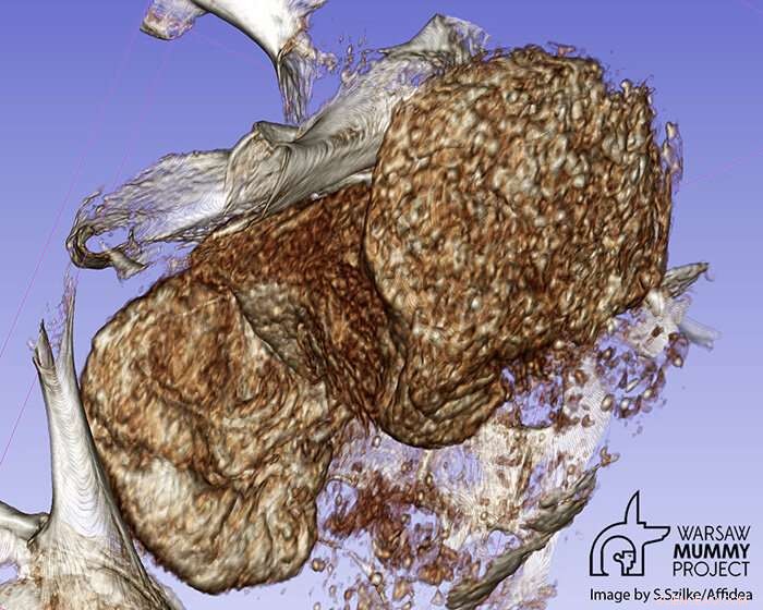 Ancient Egyptian Mummy Reveals 2,000-Year-Old Fetal Preservation