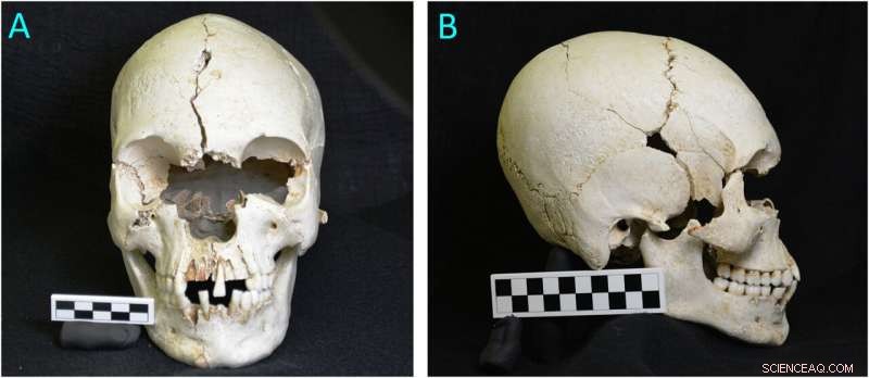 Ancient Skull Discovery Reveals Evidence of Leprosy in the Caribbean