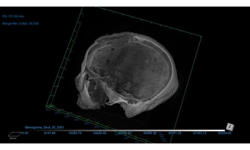 Ancient Egyptian Skull Shows Potential Evidence of Cancer Treatment