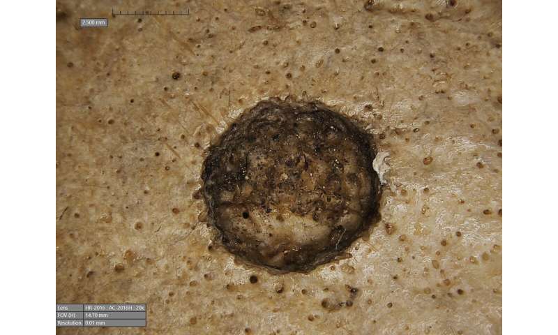 Ancient Egyptian Skull Shows Potential Evidence of Cancer Treatment