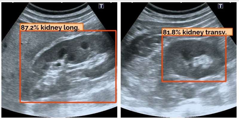 AI-Powered Ultrasound for Astronaut Medical Diagnostics - ALISSE