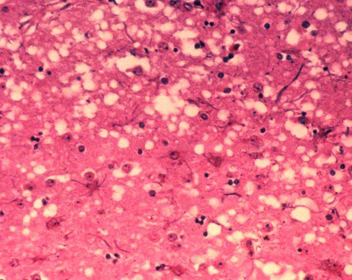 Novel Drug Compounds Show Promise in Lowering Prion Protein Levels