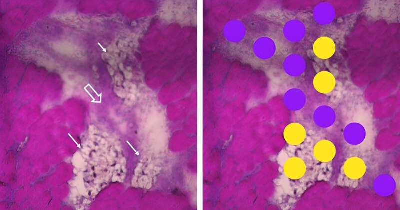 Understanding Wooden Breast Syndrome in Broiler Chickens: A New Anatomical Map