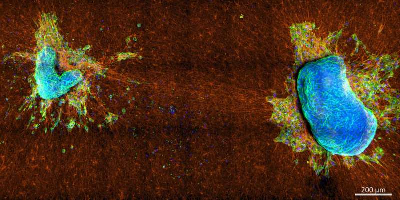 Cancer Cell Behavior: Study Reveals Tumor-Collagen Interactions