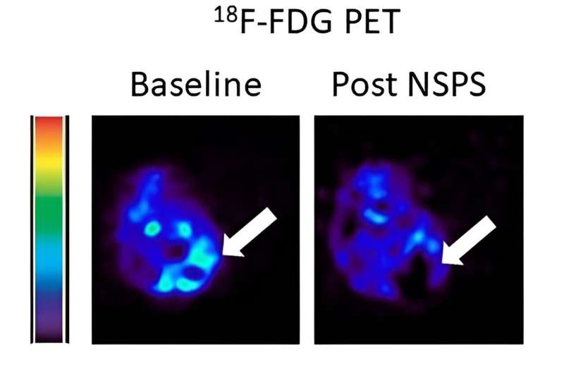 Hydroxyapatite Nanodrug Shows Promise in Targeted Cancer Therapy