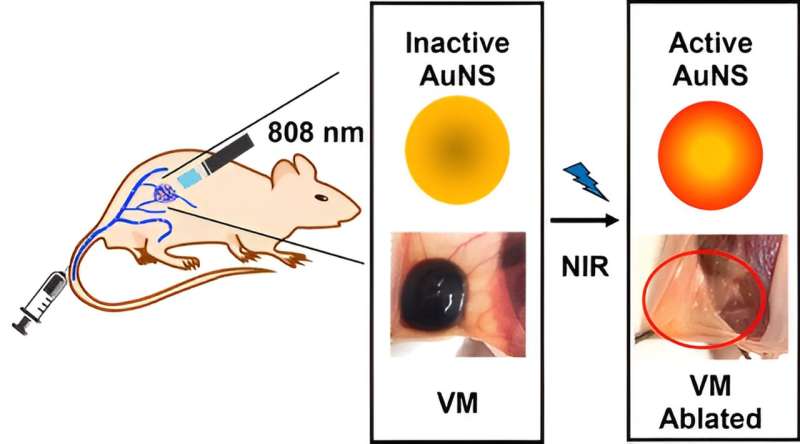Photothermal Therapy with Gold Nanoparticles for Venous Malformation Treatment