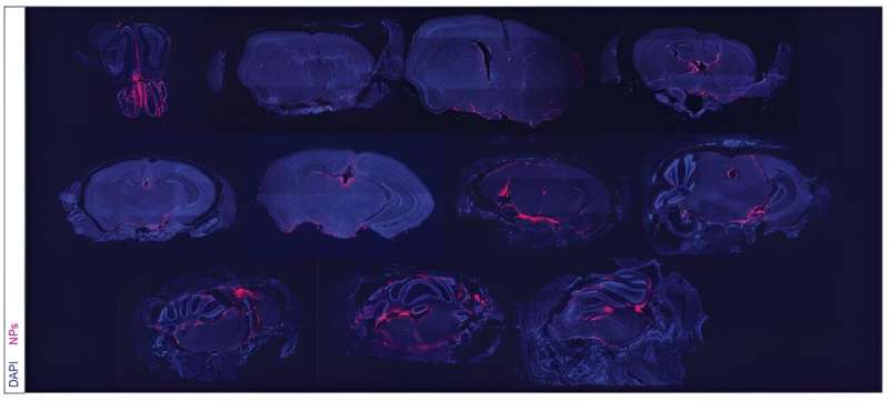 Targeted Nanoparticle Therapy Shows Promise for Brain Cancer Treatment