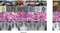 AI Neural Network Significantly Improves Anomaly Detection in Medical Scans