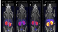 Kidney-Sparing SPECT-CT Imaging: New Compound Enhances Tumor Diagnosis Safety