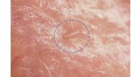 Inside the Skin: How Demodex Mites Influence Facial Health