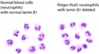 Gene Deletion Linked to Abnormal Blood Cancer Cell Nuclei