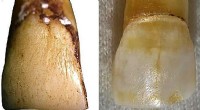 Ancient Teeth Reveal New Insights into Human Evolution