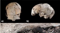 5,300-Year-Old Skull Reveals Ear Surgery: Earliest Evidence Found