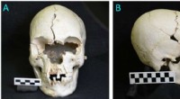 Ancient Skull Discovery Reveals Evidence of Leprosy in the Caribbean