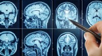 La prueba final de reflejos:cómo los médicos confirman la muerte cerebral 